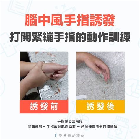 手張不開|中風復健 – 手指動作誘發與訓練 – 吱吱 ...